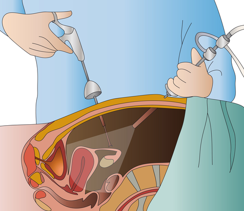 Laparoscopic surgery