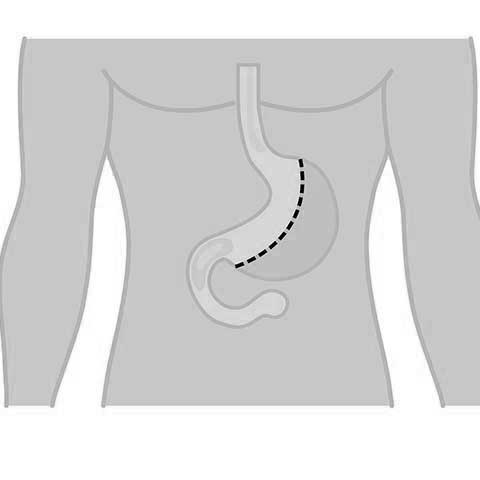 Sleeve Gastrectomy Operation Vienna - Surgery for weight loss