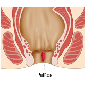 Anal Fissure - HEMORRHOIDS - Behandlung wien