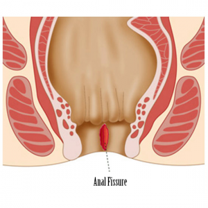 Anal Fissure - HEMORRHOIDS