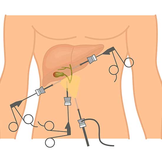 For Surgical Removal Of Gallstones We Recommend A Laparoscopy - GALLSTONES