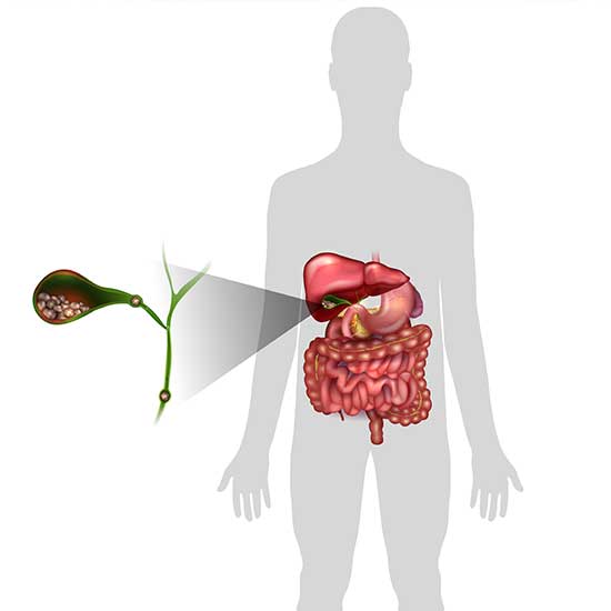 Gallstones Gallbladder Ailments - GALLSTONES