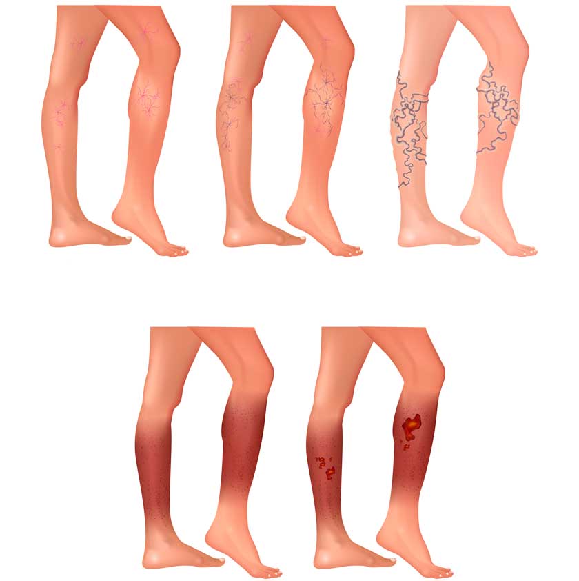 Varicose Veins Surgical Laser Methods Vienna - VARICOSE VEINS