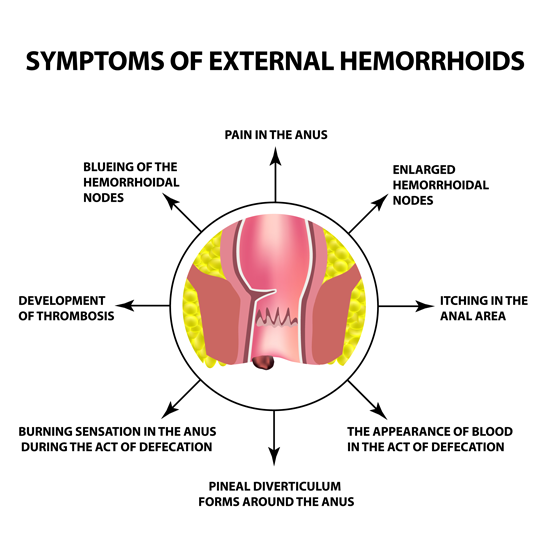 Symptoms Of External Hemorrhoids - HEMORRHOIDS